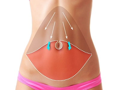 Abdominoplasty/Tummy Tuck