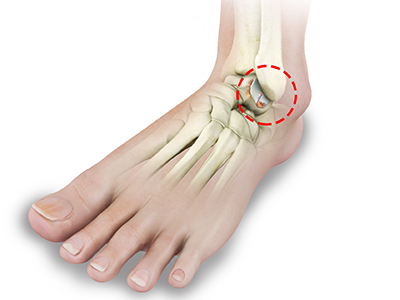Ankle Rheumatoid Arthritis