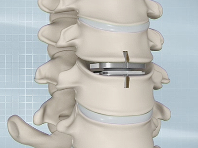 Artificial Cervical Disc Replacement