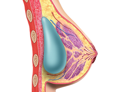 Breast Augmentation