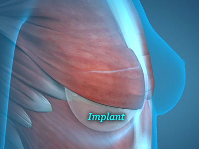 Breast Implant Revision