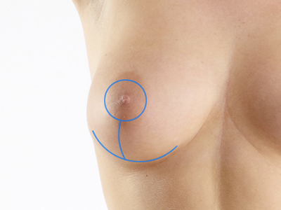 Breast Lift