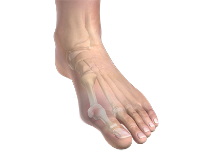 Bunion