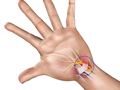 Carpal Tunnel Syndrome