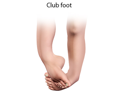 Clubfoot