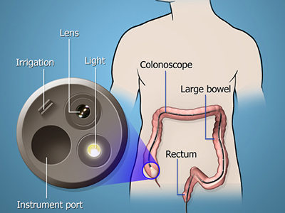 Colonoscopy