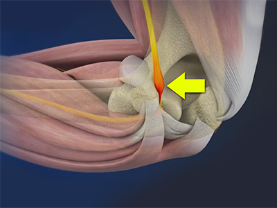 Cubital Tunnel Syndrome (Ulnar Nerve Entrapment)