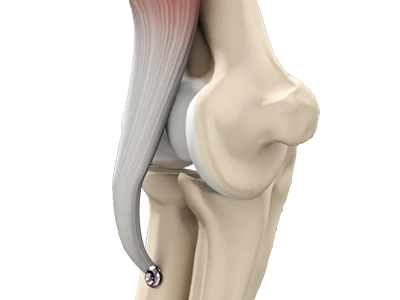 Distal Biceps Repair