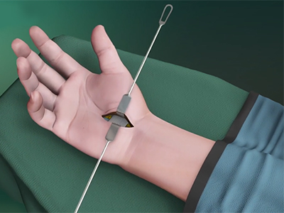 Elective/Emergency Hand Surgery