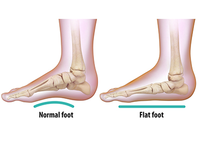 Flatfoot