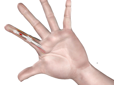 Flexor Tendon Injuries