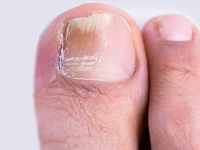 Fungal Problems (Foot)