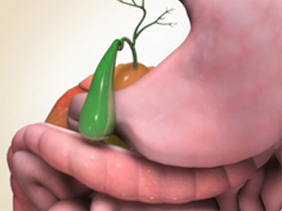 Gallbladder Surgery