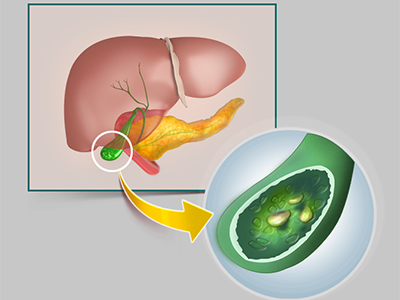 Gallbladder Disease