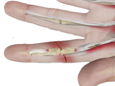 Hand Injuries and Conditions