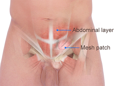 Inguinal Hernia Repair