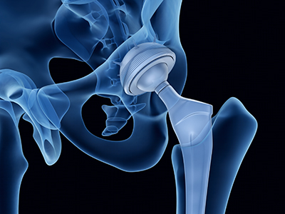 Joint Replacement