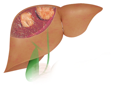 Liver Cancer