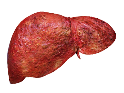 Liver Disease