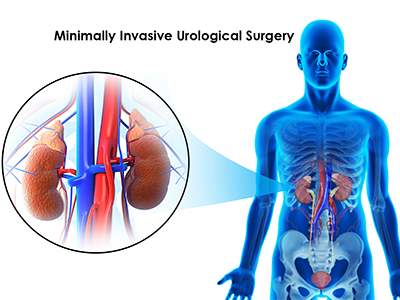 Minimally Invasive Urological Surgery