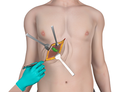 Open Cholecystectomy