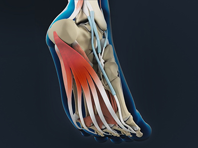 Plantar Fascia Release