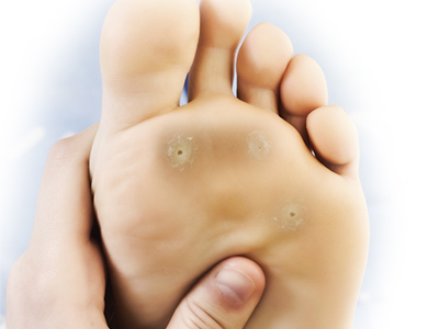 Plantar Warts