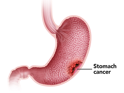 Stomach Cancer
