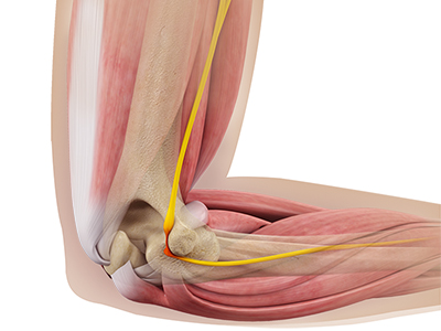 Ulnar Nerve Neuropathy